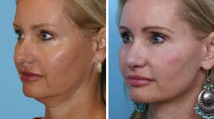 Liquid Facelift Temecula