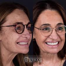 not the optimal implants....but, it is how it is :-) maximum smile line,  try in ZI-CT.