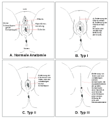 Die verbreitung von etw. verhindern, fördern, verbieten, stoppen, eindämmen, unterbinden. Weibliche Genitalverstummelung Wikipedia