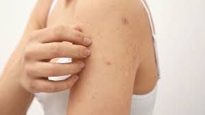 Image result for scabies in the groin area