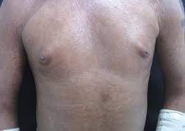 Image result for Diffuse Hyperpigmentation