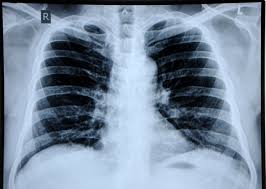 Sometimes complicated by pleural mesothelioma or bronchogenic carcinoma; Parenchymal Asbestosis Can Lead To Lung Cancer Within A Short Time Frame More Frequent Follow Up Surveillance Is Needed Than Currently Recommended Bmj Case Reports