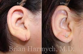 Earlobe Repair Cost In Cleveland Ohio