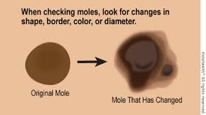 Normal moles are generally round or oval, with a smooth edge, and usually no bigger than 6mm in diameter. Melanoma For Parents Nemours Kidshealth