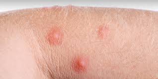 Reactia ta la muscatura de tantar: Cum TratÄƒm InÈ›epÄƒturile De Insecte In Sezonul Cald Kidmagia