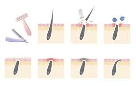6 Best Products To Treat Annoying Ingrown Hairs And How To Avoid Them In The First Place Prevention
