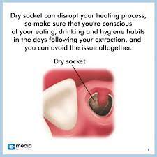Avoid smoking completely till the problem is resolved. Don T Let The Dreaded Dry Socket Make Your Healing Process Longer And More Painful Tips To Avoid Dry Socket After A Tooth Extraction We Accept Walk Ins And Same Day Emergency Services 7 Days