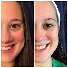 My results so far. Set myself a goal to be consistent with my skincare  morning and night. Can you see a difference? This is day 16