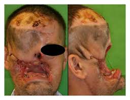 This is the slowest growing of the common forms of skin cancer and has less probability to metastasize, implying it hardly spreads to other regions or organs of the body. Neglected Basal Cell Carcinomas In The 21st Century