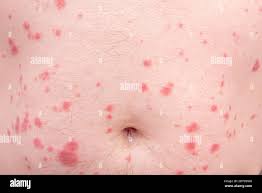 Hiv skin -Fotos und -Bildmaterial in hoher Auflösung – Alamy