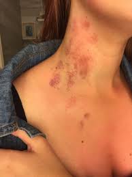 Awildtracy Love Bites Hickies Second Of Summer