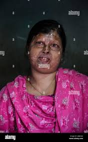 Burn scars hi-res stock photography and images