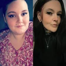 Weight loss after gastric bypass surgery