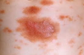 Image result for Urticaria pigmentosa children