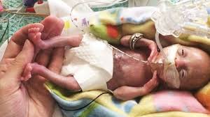 the most premature surviving baby was born at 21 weeks