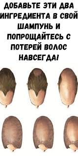 как удалить родинку в домашних условиях за 5 минут Dobavte Eti Dva Ingredienta V Svoj Shampun I Poproshajtes S Poterej Volos Navsegda Interesnyj Blog V 2020 G Kak Sdelat Volosy Gushe Domashnie Maski Dlya Volos Volosy
