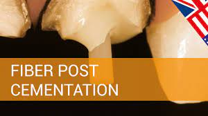 We did not find results for: Endodontics Fiber Post Cementation Youtube