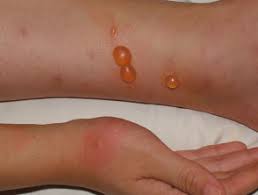 Arthropod Bites And Stings Dermnet Nz