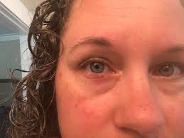 Possible bumps under son's eye, what could it be?