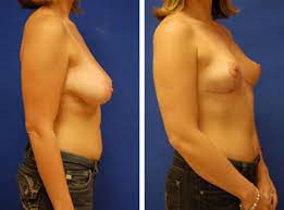 These factors fluctuate based on the location of your surgery as well as the. Breast Reduction Mobile Reduction Mammoplasty Gulf Coast Breast Enhancement Surgery Alabama