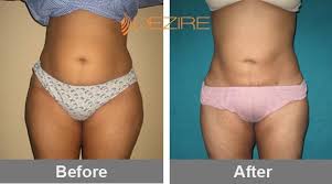 Non Surgical Liposuction Cost In Mini Tummy Tuck Liposuction Cost Abdominoplasty