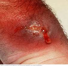 Image result for folliculitis symptoms
