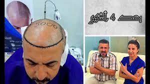 بعد 4 أشهر Kikuk 4 Month Later 4 Ay Sonra Hair Transplant Months 4 Months