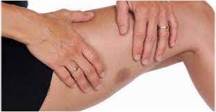 Smeđe ili crne linije pod noktima. Kako Ukloniti Modrice Po Nogama I Rukama Uzrok Lecenje