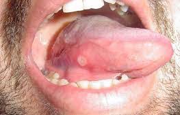 Image result for Canker sores roof of mouth
