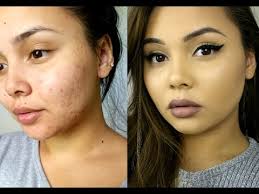 how to cover acne acne scarring