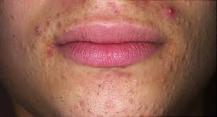 A sore, squishy lump that appears suddenly. Pictures Different Types Of Acne How To Treat Them
