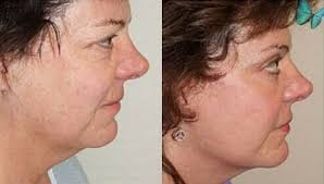 Malcolm A. Lesavoy, MD, FACS, Board Certified Plastic Surgeon