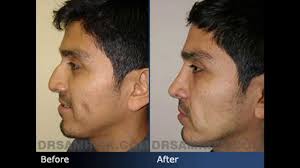 Ethnic Rhinoplasty