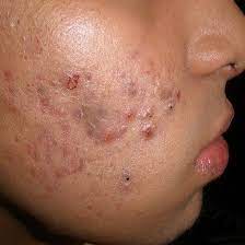 Acne En Adolescentes Facebook