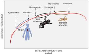 Image result for Neonatal Fluid Management
