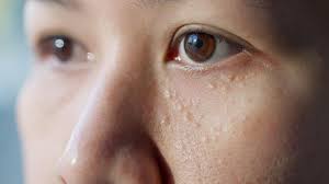 Milia: Causes and Treatment