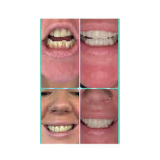 Risks associated with dental crowns