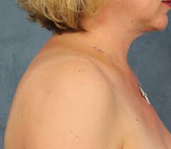 If the history is short, lymph node enlargement may be a possibility but it is likely to be lipoma, which is. Buffalo Hump Removal In Houston Tx