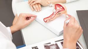 Penebalan dinding rahim atau hyperplasia endometrium adalah suatu kondisi dimana timbul permasalahan terjadinya penebalan atau pertumbuhan yang berlebihan dari dinding rahim atau endometrium, yang umumnya terjadi pengelupasan pada saat menstruasi, yang berakibat dapat. Kenali Penyebab Penebalan Dinding Rahim Dan Faktor Risikonya
