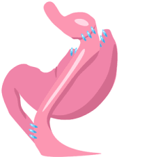 Overall, vertical sleeve gastrectomy is less risky than gastric bypass, but you'll have to check with your insurance provider first to ensure that it is covered. Gastric Bypass Vs Mini Bypass Which One Is Right For You