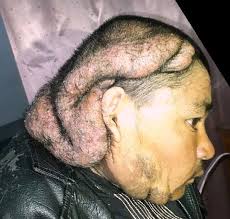 The classic issue of male pattern baldness is due to a testosterone derivative called dihydrotestosterone and the effect it has on hair follicles. Cutis Verticis Gyrata Wikipedia