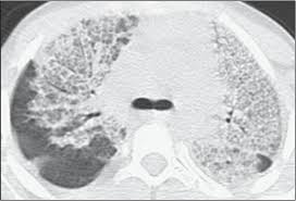 Haemophilus influenzae type b (hib): Achados Na Tomografia Computadorizada Em Pacientes Com Infeccao Pulmonar Pelo Virus Influenza A H1n1
