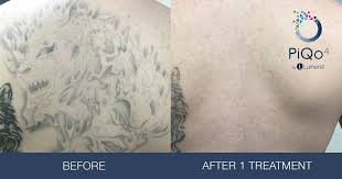 Most guys get symbols, geometric shapes, numbers, letters, or names tattooed along their spine. Tattoo Removal Austin Regional Clinic