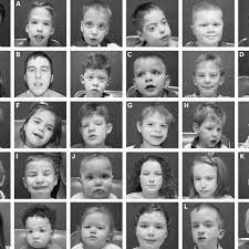 Composite Of 30 Patients Evaluated For Fg Syndrome Fgs A Definite Download Scientific Diagram