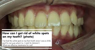 The diatomaceous earth in it has various trace minerals and thus very useful in remineralization of the teeth with white spots. White Spots On Teeth Reasons And Treatments