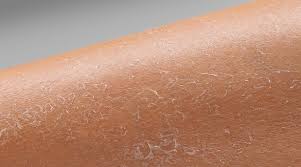 Image result for Dry Skin