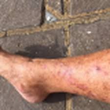 Ish-misi tregon tmerrin, çfarë i ndodhi trupit të saj pasi lahej me  Coca-Cola?