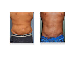 This is good for people with just a little loose skin, whose abdominal muscles are still tight, she explains. Case Study Male Tummy Tuck After Weight Loss Explore Plastic Surgery