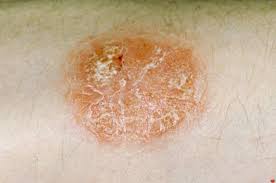 How can i stop the reply of lymphocyte t in psoriases? Types Of Psoriasis Who Gets It How They Are Affected And What To Expect