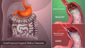 Your esophagus is the tube that carries food and liquids from your mouth to your stomach (see figure 1). Gastroesophageal Reflux Disease Gerd Symptoms Causes Risks Treatment
